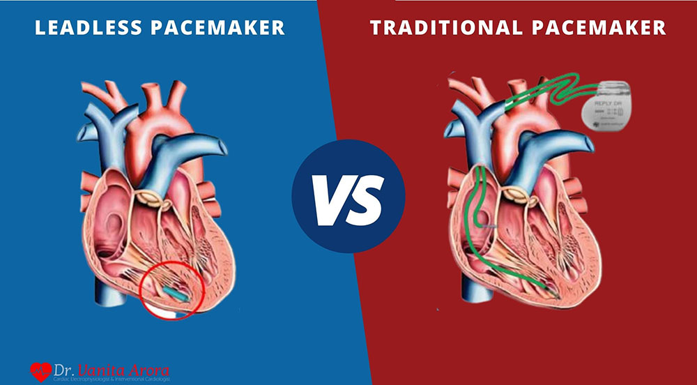 Leadless Pacemakers Alleviate Dangers of Device-Related Infection: A Review