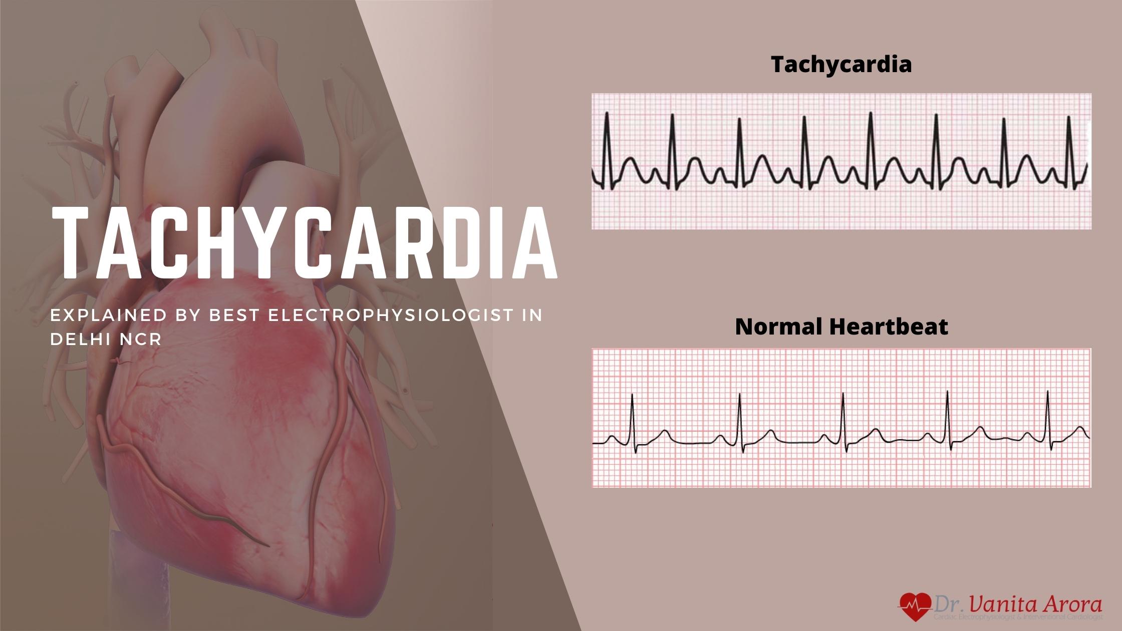 Tachycardia – Causes, Symptoms, and Treatments