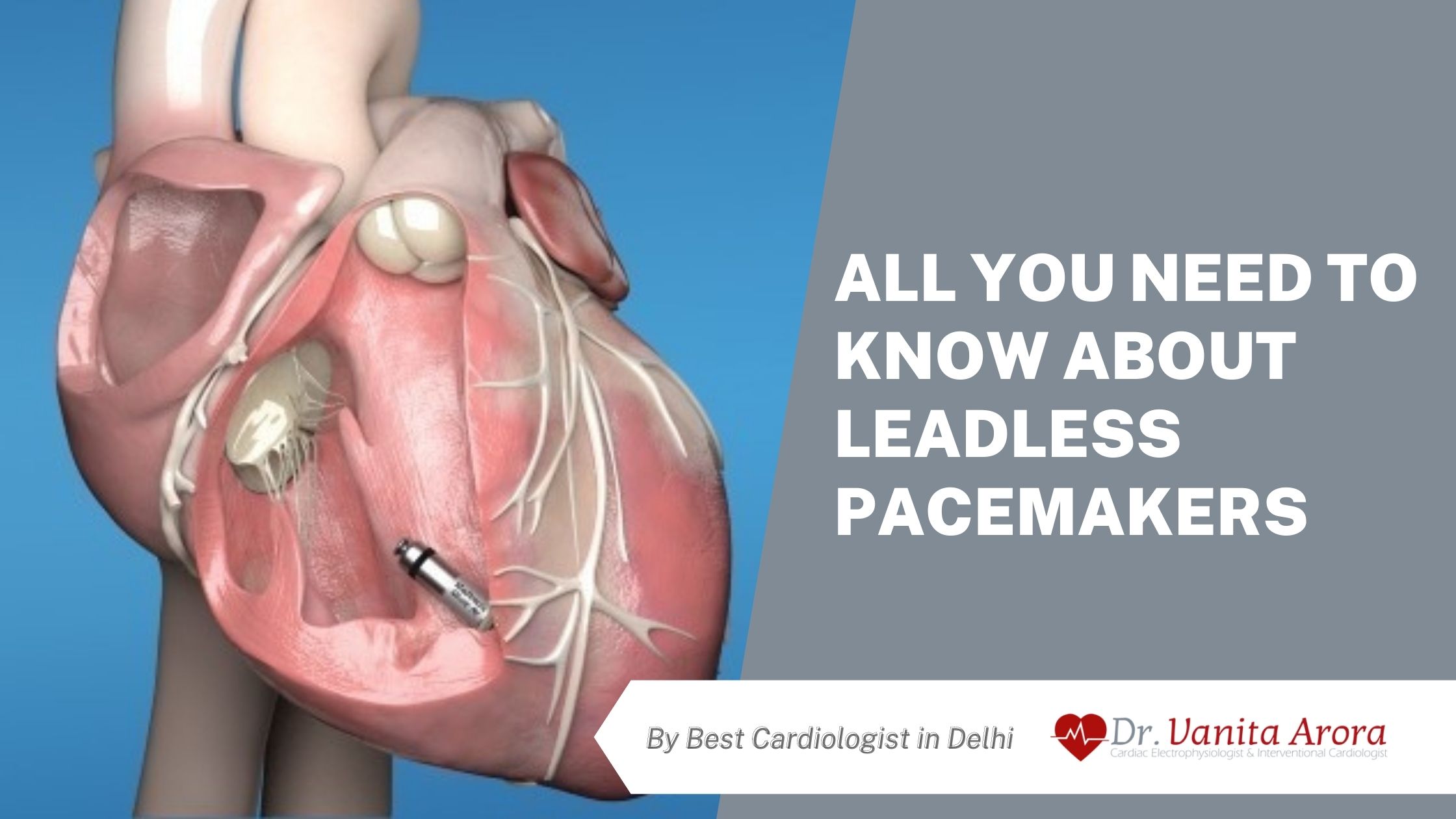 What You Need to Know About Leadless Pacemakers : By Best Cardiologist in Delhi