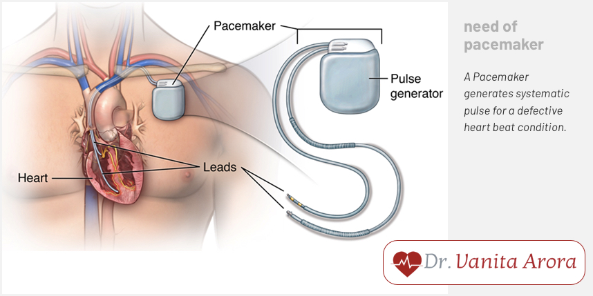 Best Pacemaker Dcotor