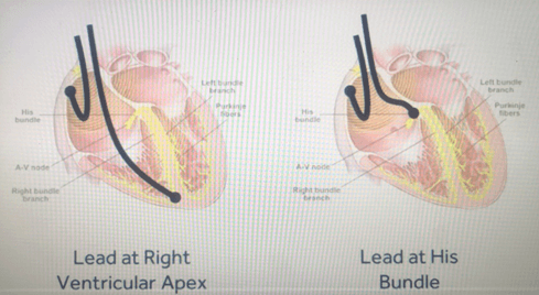 best electrophysiologist India