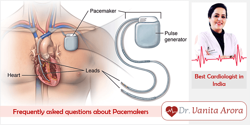 Best Cardiologist in India Answers All Your Questions About Pacemaker