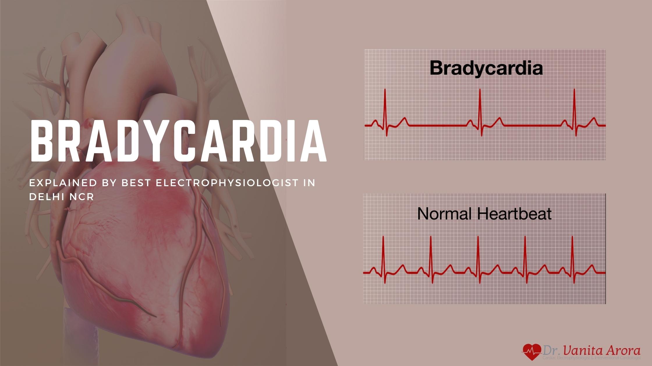 Bradycardia (Slow Heart Rate) Explained by Dr. Vanita Arora