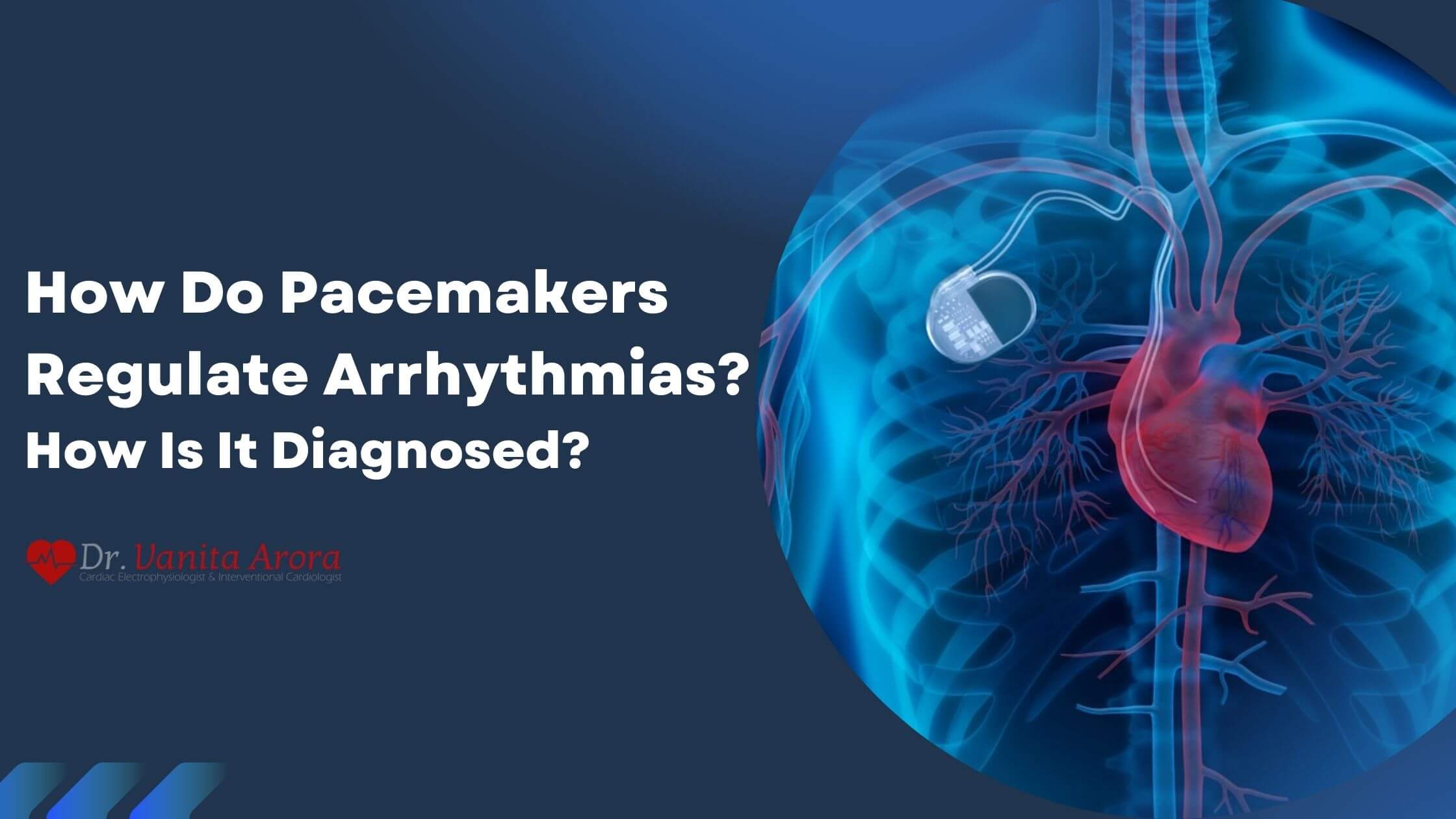How Do Pacemakers Regulate Arrhythmias? How Is It Diagnosed?