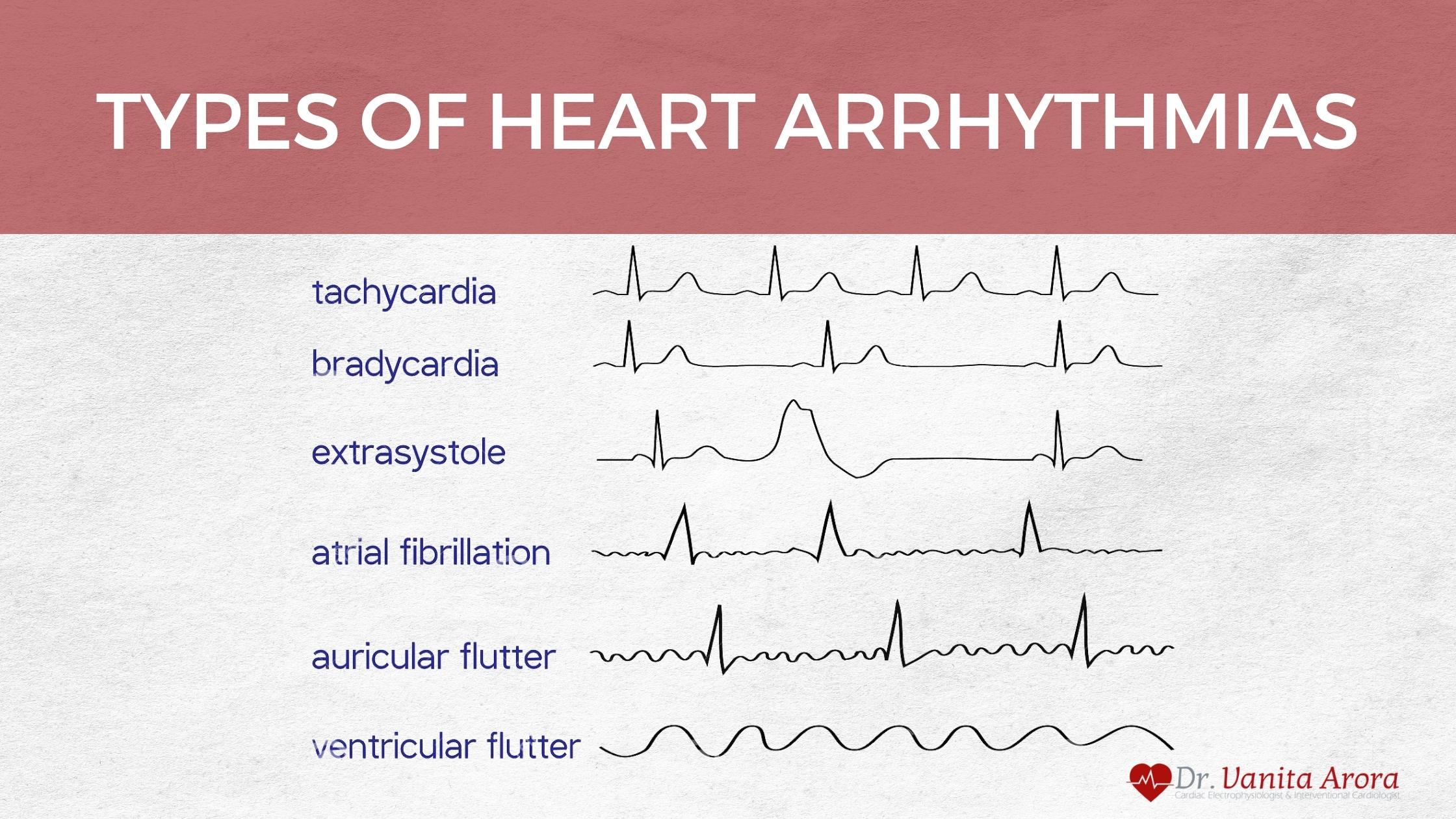 Types of Heart Arrhythmias by Best Heart Arrhythmia Specialist in India