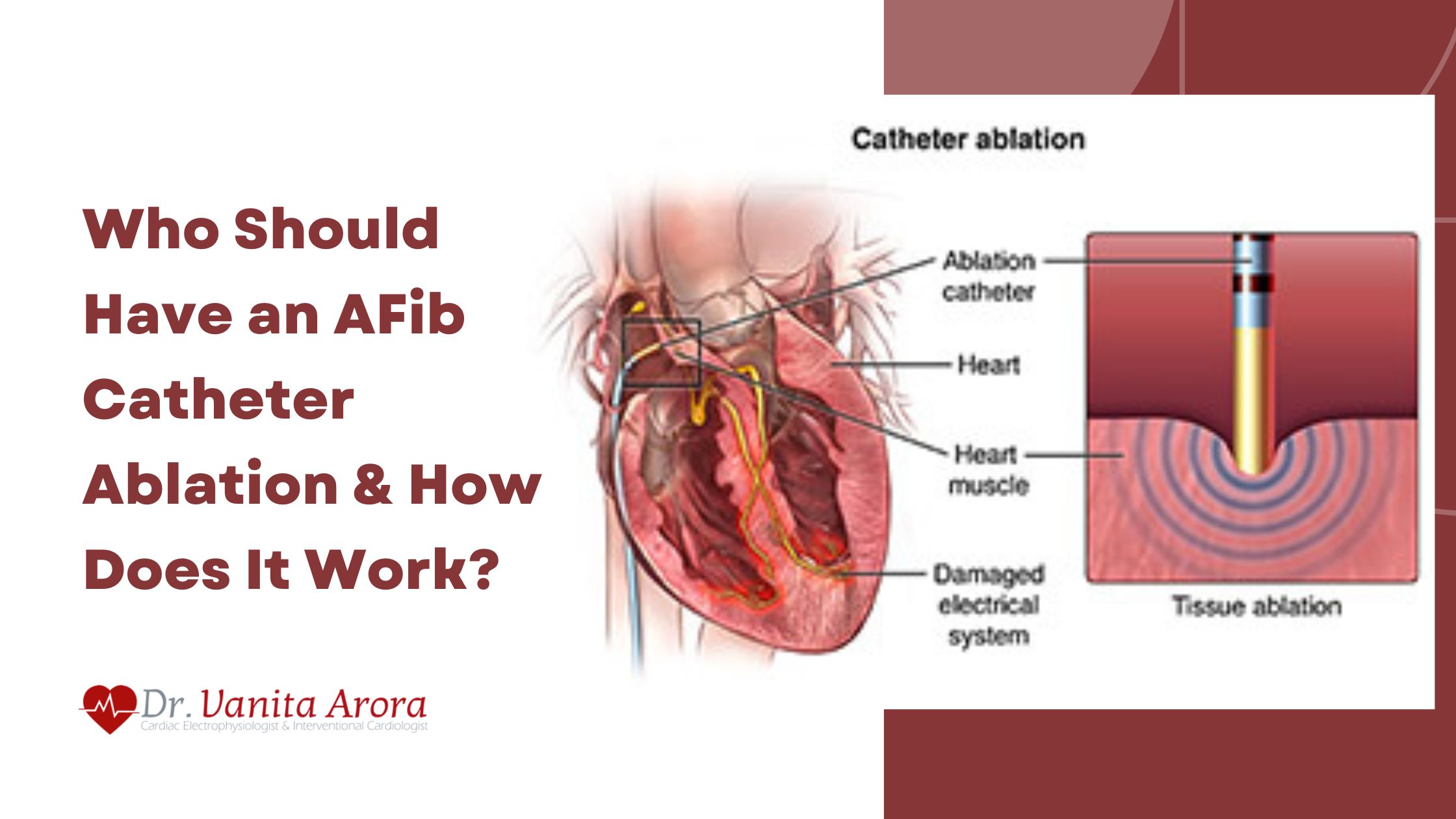 Who Should Have an AFib Catheter Ablation and How Does It Work