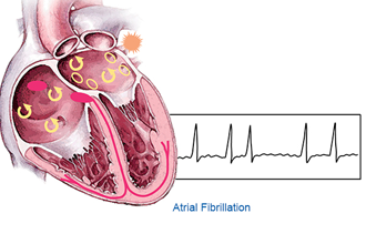 Atrial fibrillation management